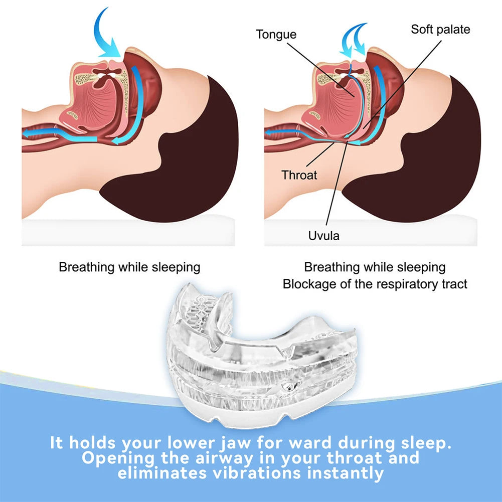 Adjustable Anti-Snoring Mouth Guard – Sleep Apnea & Teeth Grinding Relief Mouthpiece (BPA-Free)
